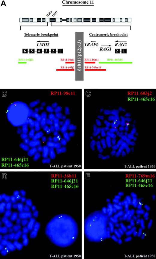 Figure 3. FISH analysis confirms the presence of del(11)(p12p13) in T-ALL patient 1950. (A) Chromosome ideogram and overview of the genomic position of the BAC clones used for FISH analysis, located in the telomeric and centromeric breakpoint regions. (B) Dual-color FISH analysis on metaphase spreads of patient 1950 using RP11-465C16 (green), RP11-646J21 (green), and RP11-98C11 (red). The wild-type allele of chromosome 11 shows 2 green and 1 red signal, whereas on the mutated allele the red signal is lost and both green signals fuse. The extrachromosomal red signal represents background. (C) Dual-color FISH analysis on metaphase spreads of the same patient using RP11-465C16 (green) and RP11-603J2 (red). The intensity of the red signal is lower compared with the wild-type allele of chromosome 11, suggesting that only part of RP11-603J2 is deleted. (D) Dual-color FISH analysis on metaphase spreads using RP11-465C16 (green), RP11-646J21 (green), and RP11-36H11 (red). The wild-type allele of chromosome 11 shows 2 green and 1 red signal, whereas on the mutated allele the red signal is lost and both green signals fuse. (E) Dual-color FISH analysis on metaphase spreads using RP11-465C16 (green), RP11-646J21 (green), and RP11-769M16 (red). The wild-type allele of chromosome 11 shows 2 green and 1 red signal, whereas on the mutated allele the red signal is lost and both green signals fuse.