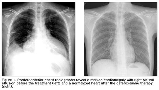 Figure 1. Posteroanterior chest radiographs reveal a marked cardiomegaly with right pleural effusion before the treatment (left) and a normalized heart after the deferoxamine therapy (right).