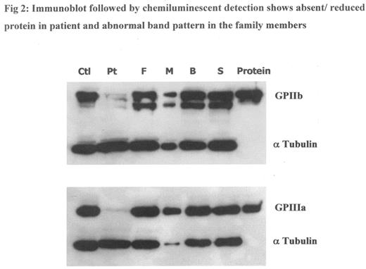 Fig 2:. Immunoblot followed by chemiluminescent detection shows absent/reduced protein in patient and abnormal band pattern in the family members