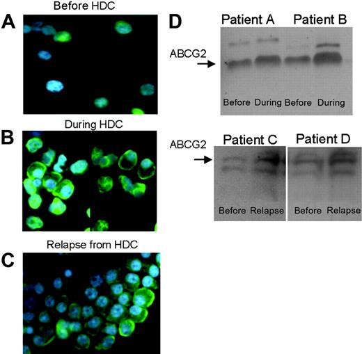 Figure 6. ABCG2 increases in patient plasma cells after high-dose chemotherapy and at relapse. (A-B) A patient bone marrow aspirate taken before (A) and during (B) HDC with melphalan and topotecan exhibited an increase in immunofluorescence of ABCG2 (green). (C) This same patient demonstrated an increase in ABCG2 expression by immunofluorescence at relapse as well. (D) ABCG2 protein expression before HDC and at relapse assessed by Western blot in 4 patients on the MTV study. Laser densitometry analysis of the immunoblots shows a 1.54- and 1.94-fold increase in ABCG2 during HDC for patients A and B, respectively, and a 3.68- and 1.34-fold increase in ABCG2 at relapse for patients C and D, respectively. In all cases, this is relative to the pre-HDC ABCG2 protein expression.