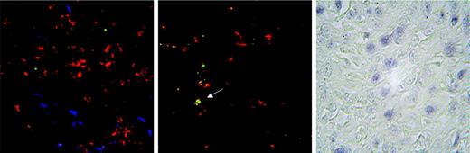 Figure 3. In situ tetramer staining of HHV8-specific CD8 T cells in KS biopsies. CD8 cells appear in red; HHV8-specific tetramer+ cells appear in green; and LANA-specific cells appear in blue. Large 3-channel merged images are shown. Compared with large tetramer– CD8 T-cell infiltrates in the vicinity of LANA+ tumoral cells (left panel), double-stained HHV8-specific CD8 T cells appear as isolated yellow cells (arrow) scarcely dispersed within the LANA– tissue (middle panel). Detection of LANA+ cells by immunohistochemistry is shown as control (right panel). Magnification, × 63.