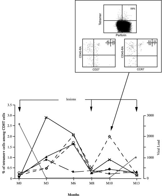Figure 4. Time course of HHV8-specific CD8 T cells in a transplant recipient with recurring KS. The figure illustrates the dynamics of HHV8 tetramer+ cells tested at approximately 3-month intervals over 2 years (beginning 4 years after grafting, indicated as M0), and shows major clinical events and viral load variations during the same period. × indicates gB; ▴, ORF65; ○, k12; ⋄, ORF6; and ▪, ORF61. • indicates the time course of HHV8 DNA load (copies/mL). Clinical relapses are indicated by arrows. The quadrant shows the phenotype profile and perforin expression of ORF6 tetramer+ cells at the indicated time.