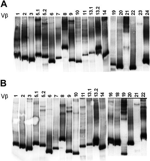 Figure 3. The TCR repertoire of BM resident T cells is highly heterogeneous. cDNA was prepared from patient total BM cells and amplified with Vβ-specific oligonucleotides. Amplified PCR products were subjected to heteroduplex analysis as described in “PCR and carrier-heteroduplex analysis.” (A-B) The heteroduplex analysis performed on patients 7 and 8. Numbers on each line indicate the amplified TCR-Vβ family.