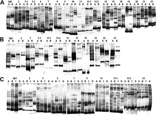 Figure 4. Shared TCR clonotype in antileukemic T-cell lines derived from BM cells and PBMCs. The carrier-heteroduplex analysis was performed as described in “PCR and carrier-heteroduplex analysis.” Carrier-heteroduplex analysis performed on LDA generated from PBMCs obtained after A-BMT (lines A) and BM cells (lines B) from patient 7 (A) and patient 8 (B). Asterisks indicate shared heteroduplex bands. (C) Shows carrier-heteroduplex analysis performed on LDA generated from PBMCs (lines A and B) and BM cells (lines C and D), respectively, before (lines A and C) and after (lines B and D) A-BMT from patient 12. Asterisks indicate shared clonotypes; arrowheads indicate 4 shared heteroduplex bands selected for further molecular characterization.