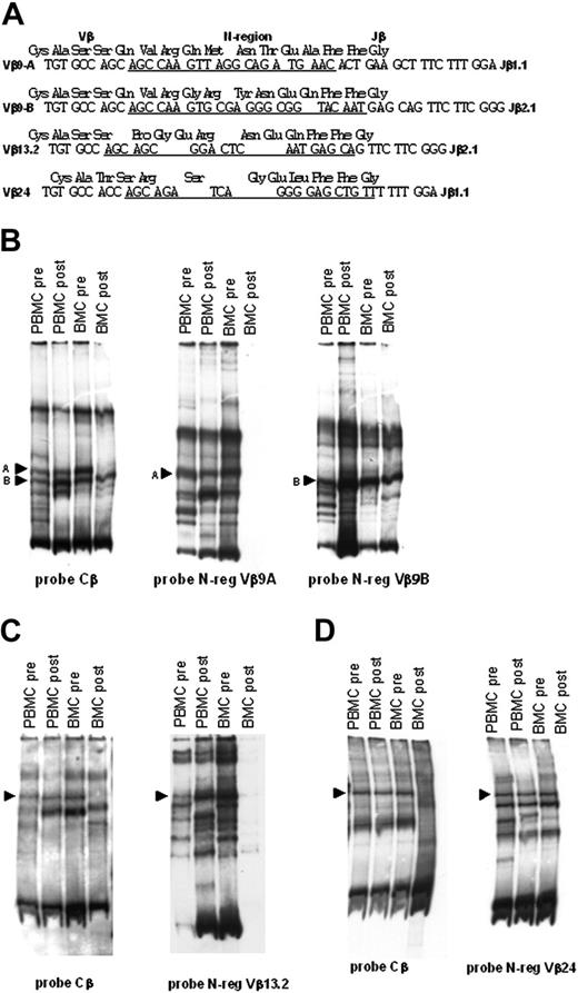 Figure 5. Molecular evidence of the transfer of antileukemia T cells with BM. The 4 selected shared Vβ clonotypes shown in Figure 4 were sequenced to generate clonotype-specific probes. These probes were used to visualize the presence of the antileukemia Vβ clonotypes in BM cells and PBMCs of patient 12 and to track their transfer into PBMCs following A-BMT. (A) Sequences of TCR Vβ-D-Jβ regions of the clonotypes indicated by the arrowheads in Figure 4. Heteroduplex bands were excised from acrylamide gels and directly sequenced. Underlined are the sequences corresponding to the N-region probes used to track these clonotypes in the T-cell lines generated from PBMCs and BM cells. (B) Filter containing the carrier-heteroduplex analysis of the Vβ9 PCR products amplified from LDA derived from PBMCs and BM cells before and after BMT, hybridized with either Cβ-specific probe or Vβ9A or Vβ9B N-regions–specific probes, as indicated at the bottom of the filters. (C) Filter containing the carrier-heteroduplex analysis of Vβ13.2 PCR products amplified from LDA derived from PBMCs and BMCs before and after BMT, hybridized with either Cβ-specific probe or Vβ13.2 N-region–specific probes, as indicated at the bottom of the filters. (D) Filter containing the heteroduplex analysis of Vβ24 PCR products amplified from LDA derived from PBMCs and BM cells before and after BMT, hybridized with either Cβ-specific probe or Vβ24 N-region–specific probe as indicated at the bottom of the filters. Arrowheads indicate the heteroduplex bands formed by the TCR clonotypes of interest and the carrier. The other bands present in filters, that hybridize with the clonotype-specific probes, are due to heteroduplexes formed by the selected clonotypes and other amplified products in the sample.