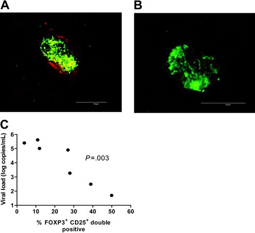 Figure 3. Plasma viral load is negatively correlated with expression of CD25 by FOXP3+ T cells. (A-B) High-magnification confocal micrograph of a FOXP3 (green) and CD25 (red) double-positive cell (A) and a FOXP3 (green) single-positive cell (B). Microbar in bottom right corner indicates 10 μm. Images were acquired using a Leica confocal scanner TCS SP II, coupled to a Leica DMR microscope (Leica, Wetzlar, Germany) using a 63×/0.75 NA oil objective. The staining reactions were developed using streptavidin-conjugated fluorophores (Alexa Fluor 488 and 594; Molecular Probes, Eugene, OR). (C) Plasma viral load was negatively correlated to the expression of CD25 by FOXP3+ T cells (r = –0.96, P = .003; Spearman correlation). This characterization was done in 7 HIV-infected patients across a wide span of viral loads (5 HIVprogs and 2 HIVnps were included in the analysis).