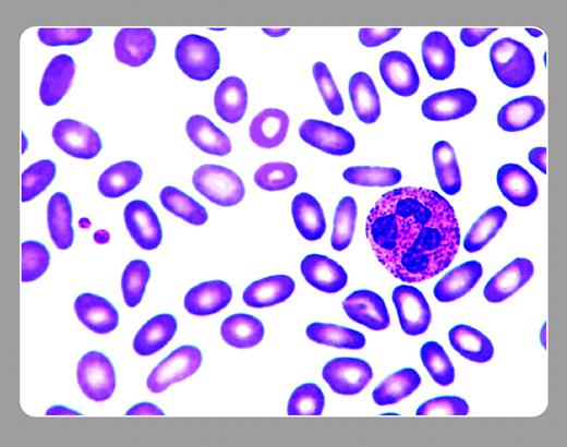 Figure 1. A 29-year-old white male who visits the emergency room after an auto injury is noted to have mild anemia (hemoglobin level 111 g/L) and a palpable spleen tip. He has a number of laboratory tests drawn, including those for HIV, EB, CMV, and hepatitis. A hematology consultant sees him and asks, “Anyone in your family with anemia or an enlarged spleen?” He answers affirmatively. . / The peripheral smear shows a prominence of uniformly elliptical cells. Given the positive family history, the smear is indicative of hereditary elliptocytosis (HE). This relatively common hereditary hemolytic anemia is autosomal dominant in transmission. Most patients are not anemic because of a compensated hemolytic anemia. But approximately 10% have a mild degree of anemia and splenomegaly. The history and a review of the peripheral smear usually make the diagnosis. . / Neil Abramson, Baptist Cancer Institute