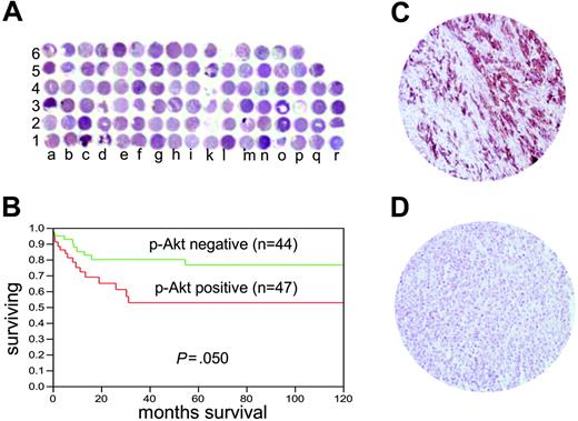 Figure 7. Tissue microarray-based p-AKT analysis in DLBCL patients. (A) Overview of the TMA containing 100 DLBCL tissue samples. (B) Kaplan-Meier survival curve of DLBCL of p-AKT expression by immunohistochemistry. (C) Immunohistochemistry of a tissue spot showing high p-AKT expression in DLBCL tumor (objective, 20×/0.70 NA). (D) A tissue spot showing negative p-AKT expression (objective, 20×/0.70 NA). Immunohistochemical staining images were obtained with a BX51 Olympus microscope and an Olympus DP12 camera (Olympus, Melville, NY). Images were viewed through a universal semi-apochromat objective lens (UPlan F1; Olympus America, Woodbury, NY). Magnifcation, 200×.