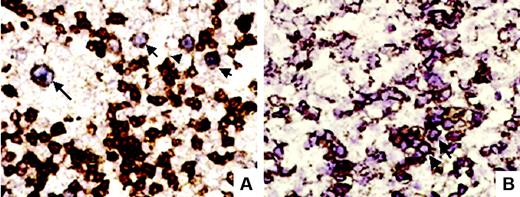 Figure 5. Double-labeling techniques. (A) EBER-ISH and CD20 double-labeling showed in this case large CD20+ B cells (arrows) showing a purplish nuclear staining corresponding to EBERs (original magnification ×400). (B) In another case, EBER-ISH and CD2 double-labeling showed clusters (arrow) of CD2 and EBER-ISH–positive cells (original magnification ×400).
