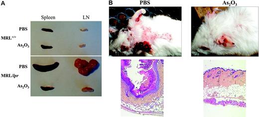 Figure 2. Absence of lymphoproliferation and regression of skin lesions in As2O3-treated MRL/lpr mice. Two-month-old mice had been treated daily for 2 months with PBS or As2O3 (5 μg/g). (A) Spleens and mesenteric LNs from 4-month-old MRL/lpr and MRL+/+ mice. (B) Skin lesions on the back and ears from 4-month-old MRL/lpr mice. Light microscopy histology of these skin lesions (bottom panels, original magnification ×50, with 5×/0.15 NA objective).