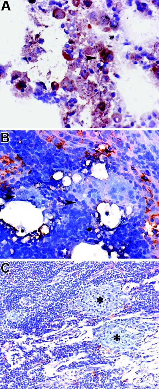 Figure 6. Variability of PTPγ expression in tissue macrophages. Sections were obtained from normal lung (A), a patient with foreign body reaction to oil-based contrast media (B), and a patient with mycobacterial lymphadenitis (C). In normal lung, strong PTPγ reactivity was observed in the cytoplasm of alveolar macrophages, some of them showing obvious anthracosis (arrowheads). In nodal foreign body reaction, numerous PTPγ+ sinus macrophages were present; no PTPγ reactivity was observed in numerous multinucleated giant cells surrounding lipidic drops (B, arrowheads). In mycobacterial lymphadenitis, only rare PTPγ cells were found outside the granuloma, and no staining was observed in epithelioid macrophages (C, asterisks). Indirect immunoperoxidase technique was applied, and nuclei were counterstained with hematoxylin.