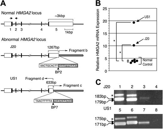 Figure 3. Effects of the chromosome 12 abnormalities in 2 patients with PNH. (A) Structure of normal and abnormal HMGA2 locus in J20 and US1. White, black, and gray boxes indicate UTRs, coding regions, and abnormally fused fragments, respectively. The exon numbers of HMGA2 are shown below the boxes. The nucleotide sequences on both sides of BP2 and BP7 (arrowheads) are shown in the white and gray boxes. The truncated HMGA2 exon 5 of J20 and US1 are indicated by the brackets with the size (bp) shown above the brackets. The bent arrows indicate the fused fragments. The 3′ UTR of exon 5 of HMGA2 on long chromosome 12 is disrupted as a result of insertion of fragment b (the 12q12q14 fragment from short chromosome 12; see Figure 1). In the case of US1, a similar disruption of exon 5 resulted from the rearrangement that occurred when material deleted from 12q (fragments c and d) was inserted into 12p (see Figure 1). (B) Real-time PCR analysis of HMGA2 transcripts in J20 and US1. The amount of HMGA2 transcripts in bone marrow cells of 5 healthy individuals and of patients J20 and US1 were quantitated by using the TaqMan MGB PCR method. The positions of the forward (right-facing arrow) and reverse (left-facing arrow) PCR primers are indicated above the normal HMGA2 locus shown in panel A. The relative expression of HMGA2 transcripts is normalized to expression of β-glucuronidase transcripts. Each value of the relative expression indicates the average of triplicate measurements. Expression of HMGA2 was greater than normal (mean ± SD, 3.87 ± 0.45) for both J20 (mean, 10.23) and US1 (mean, 19.34) (*P < .01). The long and short horizontal bars indicate average and standard deviation (SD) in healthy individuals, respectively. (C) Allele-specific expression of HMGA2. A polymorphic region (based on TC repeats) in the 5′ UTR of HMGA2 was amplified by PCR and analyzed by polyacrylamide gel electrophoresis. The products were also cloned and sequenced to characterize the polymorphisms. (Top panel) A 183-bp product (containing 29 TC repeats) was generated from the J20-derived hybrid cell line containing long chromosome 12 (lane 1), whereas a 179-bp product (containing 27 TC repeats) was generated from the cell line containing short chromosome 12 (lane 2). Analysis of the PCR product generated by amplification of cDNA derived from GPI-AP– bone marrow cells of J20 revealed only the 183-bp product (lane 3). No PCR products were visualized when the PCR template was prepared without reverse transcriptase (lane 4). (Bottom panel) A 171-bp product (containing 23 TC repeats) was generated from the US1 hybrid cell line containing the der(12) (lane 5), whereas a 175-bp product (containing 25 TC repeats) resulted from amplification of DNA from the cell line containing normal chromosome 12 (lane 6). Analysis of the PCR product generated by amplification of cDNA derived from unfractionated bone marrow cells of US1 revealed only the 171-bp product (lane 7). No PCR products were visualized when the PCR template was prepared without reverse transcriptase (lane 8). The asterisk (left of each panel) indicates the position of an uncharacterized PCR product. The abnormal allele-specific expression of HMGA2 in the bone marrow cells of US1 was confirmed by using a genetic analyzer (3100-Avant; Applied Biosystems) (not shown). For both J20 and US1, HMGA2 expression appears to be derived exclusively from the mutant allele.