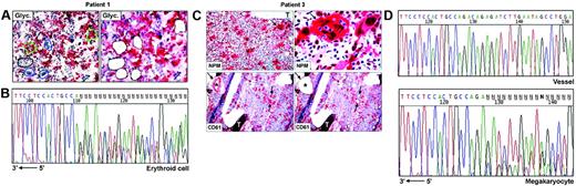 Figure 1. NPM exon 12 mutations are found in NPMc+ leukemic cells of different lineages. (A) Patient 1. Bone marrow frozen sections are stained for glycophorin A. The cells selected for analysis are shown before (left) and after laser microdissection (right, empty areas), and are labeled as follows: 1 (small group of glycophorin A-negative myeloid blasts); 2, 3, and 4 (single megakaryocytes); 5 and 6 (small groups of glycophorin A-positive erythroid precursors). APAAP; hematoxylin counterstain, 400×. (B) Sequencing analysis of NPM exon 12 in microdissected erythroid cells from patient 1. The heterozygous insertion of 4 nucleotides generates a shift in the reading frame. The arrow indicates the sequence orientation. (C) Patient 3. (Top, left) Bone marrow paraffin section showing numerous NPMc+ megakaryoytes (arrow) and small clusters of NPMc+ myeloid blasts; T indicates a bone trabecula. APAAP; hematoxylin counterstain, 200×. (Top, right) Higher magnification from the same case showing NPMc+ megakaryocyte (arrow) with marked emperipolesis (double arrows). APAAP; hematoxylin counterstain, 1000×. (Bottom, left) CD61+ megakaryocytes selected for laser microdissection are indicated (arrows); CD61+ endothelial cells of a blood vessel (asterisk) were used as negative control. APAAP; hematoxylin counterstain, 200×. (Bottom right) Empty areas correspond to microdissected megakaryocytes after laser catapulting. APAAP; hematoxylin counterstain, 200×. (D) Chromatograms of NPM exon 12 sequences obtained from genomic DNA of vessel endothelial cells (control) (top) and megakaryocytes (bottom), microdissected from patient 3. Although a wild-type sequence is detected in the control DNA (vessel), the leukemic megakaryocytes show a heterozygous insertion of 4 nucleotides, creating a shift in the reading frame. The arrow indicates the sequence orientation.