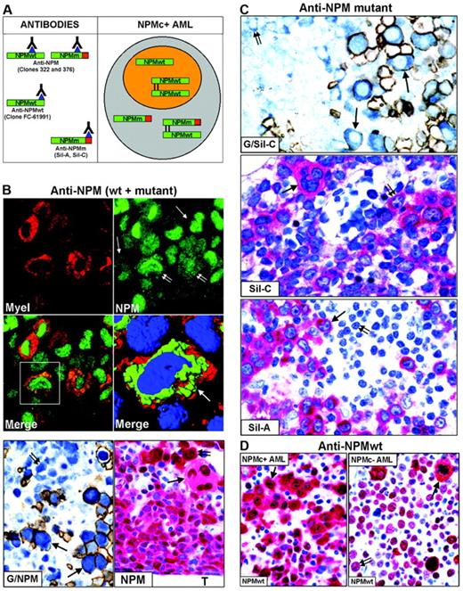 Figure 2. Mutated NPM proteins are found in NPMc+ leukemic cells of different lineages. (A, left) Epitopes recognized by anti-NPM antibodies. Clones 322 and 376 do not distinguish between wild-type (NPMwt) and mutant NPM (NPMm); clone FC-61991 recognizes NPMwt but not NPMm; the Sil-A and Sil-C antibodies recognize NPMm but not NPMwt. The red square area in NPMm indicates the mutated C-terminal portion of nucleophosmin. (Right) Schematic representation of subcellular distribution of NPMwt, NPMm, and NPMwt/NPMm heterodimer molecules in nuclear (orange) and cytoplasmic (gray) compartments of NPMc+ AML. (B, top) Double immunofluorescence staining of paraffin section for myeloperoxidase (Myel: red, cytoplasmic) and nucleophosmin (NPM: green, nuclear plus cytoplasmic) from a AML-M6 (×1000); single arrows indicate NPMc+ erythroid blasts and double arrows NPMc+ myeloid blasts. (Merge) Myeloid blasts (square box) show cytoplasmic colocalization of myeloperoxidase and NPM (×1000). (B, middle) Three-dimensional reconstruction at confocal microscope of the cell in the square box (arrow) (myeloperoxidase, red; NPM, green; nucleus, blue). (B, bottom) Double immunoenzymatic staining (G/NPM) of AML-M6. Leukemic proerythroblasts (arrows) are double-stained for NPM (clone 376) in blue (nucleus plus cytoplasm) and glycophorin in brown (surface). Myeloid blasts (double arrow) are glycophorin A-negative and show nuclear plus cytoplasmic NPM positivity. APAAP/Immunoperoxidase; no counterstain, ×1000. Multilineage involvement in NPMc+ AML (figure indicated as NPM). Nuclear plus cytoplasmic expression of NPM (clone 376) is seen in leukemic myelo-monocytic cells adjacent to bone trabecula (T), occasional strongly positive proerythroblasts (double arrow) and megakaryocytes (arrow); APAAP; hematoxylin counterstain, ×1000. (C, top) Proerythroblasts (arrows) are double-stained for NPM mutant (Sil-C) in blue (cytoplasmic-restricted) and glycophorin in brown (surface). Myeloid blasts (double arrow) are glycophorin-negative and show cytoplasmic-restricted expression of NPM mutant (APAAP/Immunoperoxidase; no counterstain, ×1000). (Middle) Cytoplasmic-restricted expression of mutant NPM protein in myeloblasts, cluster of proerythoblasts (double arrow), and isolated megakaryocyte (arrow). APAAP; hematoxylin counterstain, ×1000. (Bottom) Myeloblasts (arrow) show cytoplasmic-restricted expression of mutant NPM, whereas lymphoid cells (double arrow) are Sil-A negative (APAAP; hematoxylin counterstain, ×1000). (D) Wild-type NPM expression (clone FC-61991) is nuclear plus cytoplasmic (arrow) in leukemic cells of NPMc+ AML (left) but nucleus-restricted in NPMc– AML (right, double arrow) with exception of a mitotic figure (arrow). APAAP; hematoxylin counterstain, ×1000.