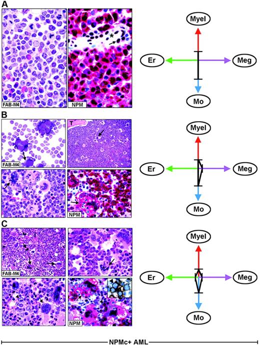 Figure 3. Each FAB category contains a mixture of leukemic cells of different lineages. (A) Hematoxylin and eosin (left) and NPM staining (right, APAAP; hematoxylin counterstain, ×1000) of an AML-M4, showing nuclear plus cytoplasmic NPM expression only in myeloid and monocytic cells. The arrow indicates the nucleus-restricted positivity in endothelial cells of a blood vessel (asterisk). (B) AML-M4 with myelo-monocytic and megakaryocytic involvement. (Top left) Myelo-monocytic cells in a marrow smear. (May-Grünwald-Giemsa, ×1000) The bone marrow biopsy from the same case shows an increased number of megakaryocytes (top right, arrow, hematoxylin and eosin, ×1000) displaying marked emperipolesis (bottom left, arrow hematoxylin and eosin, ×1000); T indicates a bone trabecula. (Bottom right) NPM (clone 376) is nuclear and cytoplasmic (red) in virtually all myelo-monocytic cells and megakaryocytes (arrow). (C) Bone marrow biopsy from AML-M4 with multilineage involvement, showing heterogeneous morphologic features in different areas. (Top left, hematoxylin and eosin ×400) Increased number of dysplastic megakaryocytes (arrows). (Top, right, hematoxylin and eosin, ×1000) Area with mixture of myelo-monocytic cells and displastic megakaryocytes (arrow). (Bottom, left, hematoxylin and eosin, ×1000) Area with mixture of proerythroblasts (arrowhead) and dysplastic megakaryocytes (arrow). (Bottom right, APAAP; hematoxylin counterstain, × 1000) NPM expression (clone 376) is detected in the nucleus and cytoplasm (red) of proerythroblasts (arrowhead) and megakaryocytes (arrow). The same NPM staining pattern (not shown) is also seen in myelomonocytic leukemic cells in other areas of the biopsy. The inset shows double immunostaining for surface glycophorin A (brown) and NPM (blue) in proerythroblasts from the same biopsy (immunoperoxidase/fast blue APAAP, no counterstain, ×1000). (Right panels). The ratios and type of lineages involved in each case (A-C) are schematically illustrated by the 4-axis diagram. Myel indicates myeloid; Mo, monocytic; Er, erythroid; Meg, megakaryocytic.