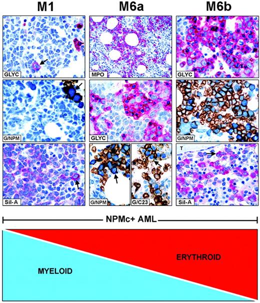 Figure 4. FAB categories are created by mixtures of NPMc+ leukemic cells of different lineages. Combination of myeloid and erythroid cells is taken as an example of how FAB categories are created in NPMc+ AML. (Left panel, M1) NPMc+ AML of M1-type showing numerous glycophorin A-negative myeloid blasts (blue) and rare glycophorin A-positive (red) proerythroblasts (GLYC, arrow; APAAP; hematoxylin counterstain, ×1000) that express cytoplasmic NPM, as shown by double staining for glycophorin A(brown)/NPM (blue) (G/NPM, arrow; immunoperoxidase/fast blue APAAP, no counterstain, ×1000), and labeling in red (cytoplasmic-restricted) of the mutant NPM (Sil-A, arrow; APAAP; hematoxylin counterstain, ×1000). (Middle panel, M6a) NPMc+ AML of M6a type characterized by equal representation of myeloperoxidase-positive myeloid blasts (MPO, red; APAAP; hematoxylin counterstain, ×400) and glycophorin A-positive erythroid cells (GLYC, red; APAAP; hematoxylin counterstain, ×1000). Erythroid cells double stain for surface glycophorin A (brown)/cytoplasmic NPM (blue) (G/NPM, arrow) and for surface glycophorin A (brown)/nuclear C23 (blue) (G/C23, arrow; immunoperoxidase/fast blue APAAP, no counterstain, ×1000). (Right panel, M6b) NPMc+ AML of M6b type showing a predominant population of erythroid precursors (GLYC, red; APAAP; hematoxylin counterstain, ×1000) expressing cytoplasmic NPM as documented by double staining for surface glycophorin A (brown)/cytoplasmic NPM (blue) (G/NPM; immunoperoxidase/fast blue APAAP, no counterstain, ×1000), and by labeling in red (cytoplasmic-restricted) for mutant NPM (Sil-A, arrow; APAAP; hematoxylin counterstain, ×1000); T indicates a bone trabecula.
