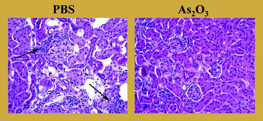 Kidney sections from 4-month-old MRL/lpr mice treated daily for 2 months with As2O3 (5 μg/g) or PBS. Lymphoid infiltrates (arrows) are detected in PBS-treated (left panel), but not As2O3-treated (right panel), mice.
