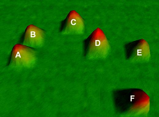 Figure 1. VxInsight clusters in adult AML. Six distinct clusters of AML patients are identified based on gene expression profiles and designated A to F. The data are visualized as a 3-dimensional terrain map with 2-dimensional distances reflecting gene expression profile correlates and the third dimension representing cluster membership density. Additional information on VxInsight is available at the University of New Mexico Health Sciences Center website and Sandia National Laboratories website.44,47