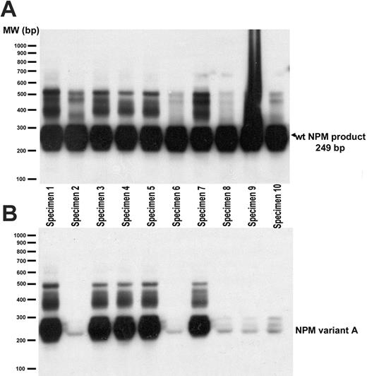 Figure 5. Nucleophosmin (NPM1) gel analysis/hybridization. (A) Hybridization to wild-type NPM1 probe confirms the presence of wild-type NPM1 in 7 patient specimens and 3 cell lines (specimens 8 to 10). All 165 AML samples contained wild-type NPM1. (B) Patient specimen (1, 3-5, 7) hybridized to NPM1 variant A probe consistent with an NPM1 variant type A mutation (see Supplement).44