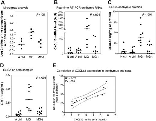 Figure 2. CXCL13 expression in thymus and sera during MG. (A) Microarray corresponding to CXCL13 gene expression level in thymuses of adult controls (A ctrl), untreated MG patients (MG), and MG patients treated by corticotherapy (MG-t) compared with the RNA reference obtained for each array. The y-axis shows the log 2 ratio centered on zero. Each dot corresponds to one comparison to the RNA reference. (B) Amplification by real-time PCR of CXCL13 gene in thymic samples from newborn girl controls (N ctrl), A ctrl, MG, and MG-t patients. Each dot represents the mean value of 3 different determinations. (C) Determination by ELISA of CXCL13 level expression in thymic samples from N ctrl, A ctrl, MG, and MG-t patients. Each dot represents the mean value of duplicates. (D) Determination by ELISA of CXCL13 level expression in sera samples from A ctrl, MG, and MG-t patients. Each dot represents the mean value of duplicates. In panels A-D, the bar represents the median value and the P values were obtained by the nonparametric one-way analysis of variance (Kruskal-Wallis test). (E) Correlation of CXCL13 expression determined by ELISA in thymic extracts and sera from MG untreated patients. The R2 and P value were obtained by the nonparametric correlation test (Spearman test).