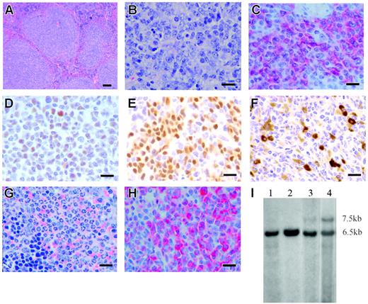 Figure 7. Histopathology and immunohistochemistry of Mll-AF4 mice with leukemia or lymphoma. (A) Spleen section from a representative Mll-AF4 mouse with lymphoma stained with H&E and shown at low magnification demonstrates loss of normal architecture resulting from follicular B-cell lymphoma. Bar represents 200 μm. (B) The same spleen section is shown at high magnification. Bar represents 50 μm. (C) Liver section indicates B220+ lymphoma cell infiltration. Bar represents 50 μm. (D) Liver section from the same specimen shows Bcl-6+ lymphoma. Bar represents 50 μm. (E) Spleen section shows PAX5+ lymphoma cells. Bar represents 50 μm. (F) Small intestine section shows IgM+ lymphoma cells. Bar represents 50 μm. (G) Spleen section from an Mll-AF4 mouse with MPD-like myeloid leukemia stained with H&E indicates loss of normal architecture and heavy infiltration of myeloid cells at all stage of maturation. Bar represents 50 μm. (H) Spleen section from a Mll-AF4 mouse with MPD-like myeloid leukemia stained with myeloperoxidase. Bar represents 50 μm. (I) IgH rearrangements in the spleen and lymph nodes of an Mll-AF4 mouse with follicular B-cell lymphoma. Lane 1, spleen from a wild-type mouse; lane 2, kidney from the same wild-type mouse; lane 3, spleen from an Mll-AF4 mouse; lane 4, lymph node from the same mouse. gDNA was digested by EcoRI. Germline band, 6.5 kb; additional band in lane 2 and lane 3, 7.5 kb.