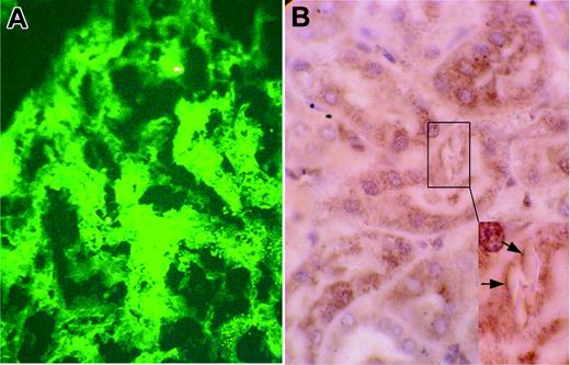 Figure 4. Transgenic mice kidneys by immunofluorescence and immunostaining. (A) Homozygous κ-CHEB mice. Immunofluorescence microscopy, polyclonal rabbit antibody against human κ-light chain, original magnification × 400. Strong peripheral staining of crystalline inclusions in the cytoplasm of proximal tubular cells. No staining was observed in glomeruli and distal tubule basement membranes and lumens. Proximal tubular cells were not stained by the anti-λ polyclonal antibody (not shown). (B) Homozygous κ-CHEB mice. Immunostaining with a rabbit polyclonal anti–mouse cathepsin B, original magnification × 1000. Heavy cytoplasmic labeling was observed in proximal tubule sections. Inset: strong peripheral staining of intracytoplasmic vacuoles containing crystalline inclusions (arrows).