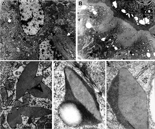 Figure 5. Electron microscopic studies. (A) Homozygous κ-CHEB mice. Electron microscopy, original magnification × 4000: numerous crystalline (arrows) and osmiophilic inclusions within the cytoplasm of proximal tubular cells. Note the alteration of apical brush border membrane (*) and duplication of the tubular basement membrane (white arrow). (B) κ-CHEB/κ-del mice. Electron microscopy, original magnification × 4000: proximal tubular cells contained few crystalline inclusions (arrows) and morphology of the brush border was preserved. (C) Homozygous κ-CHEB mice. Electron microscopy (original magnification × 12 000). Crystalline inclusions bound in a single membrane, probably related to lysosomes. Note the morphologic alterations of mitochondria. (D) Homozygous κ-CHEB mice. Electron microscopy (original magnification × 50 000) and (E) Patient CHEB. Kidney biopsy. Electron microscopy (original magnification × 80 000). Similar ultrastructural appearance of osmiophilic crystalline inclusions in patient CHEB and κ-CHEB mice, with an 80-Å periodic striation.