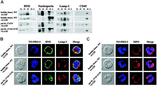 Figure 5. Intracellular mistrafficking and cytoplasmic accumulation of MT-HNE proteins in neutrophil granulocytes of patients with SCN. (A) Localization of HNE protein (29-34 kDa) in subcellular fractions of primary polymorphonuclear cell lysates obtained by differential centrifugation. Analysis of the following fractions: P1 (nuclear and nuclear-associated proteins), P2 (mitochondria, lysosomes, ER), P3 (plasma membrane, secretory and other vesicles, Golgi complex), and S (soluble cytosolic proteins). TL indicates total cell lysate. A healthy donor without G-CSF treatment and a healthy donor who received G-CSF subcutaneously for 2 days served as controls. Both SCN patients received daily treatment with G-CSF. Each patient carries a heterozygous mutation in ELA2 (patient 1, C122Y; patient 2, ΔV161-F170). Localization of cellular marker proteins in subcellular fractions was obtained by differential centrifugation. Nucleoporin (62 kDa) is a nuclear and cytoplasmic pore complex protein, thus defining P1, P3, and S. Lamp-2 (120 kDa) is a lysosomal membrane protein that fractionates mainly in P2, and CD45 (180-220 kDa) is a plasma membrane–associated protein mainly localized in fraction P3. (B) Subcellular localization of WT-HNE in granulocytes of healthy donors with or without rh-G-CSF treatment or of MT-HNE in granulocytes of a patient with SCN and carrying a heterozygous mutation in ELA2 (patient 2, ΔV161-F170). Cells were stained with anti-HNE (green) and lamp-3 (lysosomal marker; red). TO-PRO-3 was used to counterstain the nuclei (blue). Yellow represents colocalization of HNE protein with lamp-3. (C) Subcellular localization of MPO in granulocytes of healthy donors with or without rh-G-CSF treatment or in granulocytes of a patient with SCN and carrying a heterozygous mutation in ELA2 (patient 2, ΔV161-F170). Cells were stained with anti-MPO (red). TO-PRO-3 was used to counterstain the nuclei (blue).