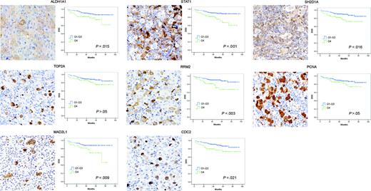 Figure 2. Analysis of the relationship between gene expression and outcome in the validation set of patients. Immunohistochemical analysis of the expression of 8 selected genes in the validation series of patients using TMAs. The patients were grouped into quartiles according to the protein expression level of each marker, and the DSS of the fourth quartile (the one with the highest expression) was compared with that of the rest of the series (quartiles 1 to 3). For each marker, a representative field of a stained tissue section and the Kaplan-Meier curves are shown. Note ALDH1A1 and STAT1 immunostaining, restricted mainly to macrophages; SH2D1A immunostaining mainly in T cells; and TOP2A, RRM2, PCNA, MAD2L1, and CDC2 overexpression in the neoplastic H/RS cells. Micrographic images were obtained with a BLISS Slide Scanner (Bacus Laboratories) equipped with a Zeiss Axioplan 2 microscope (Zeiss, Oberkochen, Germany). A 40 ×/0.75 objective lens was used to visualize images, which were acquired through software provided with the BLISS scanner.