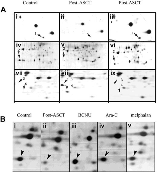 Figure 1. Differential expression of proteins associated with cell proliferation using 2D analysis. (Ai,iv,vii) Control fibroblasts; (ii,v,viii) pretreatment fibroblasts; (iii,vi,ix) posttreatment fibroblasts. These detailed pictures of the silver-stained gels demonstrate that protein expression pattern in the patient's fibroblasts after treatment mirrors that observed in control fibroblasts. Arrows identify the following proteins: (1) Cu/Zn SOD; (2) Mn SOD; (3) Profilin I; and (4) MIF. (B) Effect of the different drugs used in the conditioning procedure on the expression of MnSOD (arrowheads) in the patient fibroblasts. All drugs increased the expression of MnSOD in the patient to levels similar to control fibroblasts. (i) Control fibroblasts; (ii) patient fibroblasts untreated; (iii-v) patient fibroblasts treated with BCNU (iii), Ara-C (iv), or melphalan (v). All images were acquired with a GS-800 scanner (BioRad, Palo Alto, CA) and processed with Adobe Photoshop 7.0 (Barcelona, Spain).