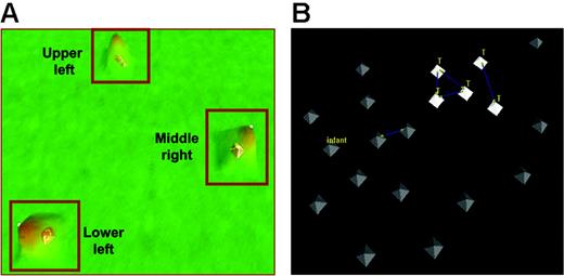 Figure 3. VxInsight analysis for 60 patients at relapse. (A) The VxInsight program located and positioned clusters and used a mountainous terrain metaphor to display the results. Mountains are shown over the clusters such that the height of each mountain represents the number of elements in that cluster. VxInsight defined 3 clusters from the entire cohort of 60 patients. (B) A detailed view of the middle-right cluster shows that all the early-relapse T-cell patients are closely clustered together. Blue lines indicate the strongest similarity links.