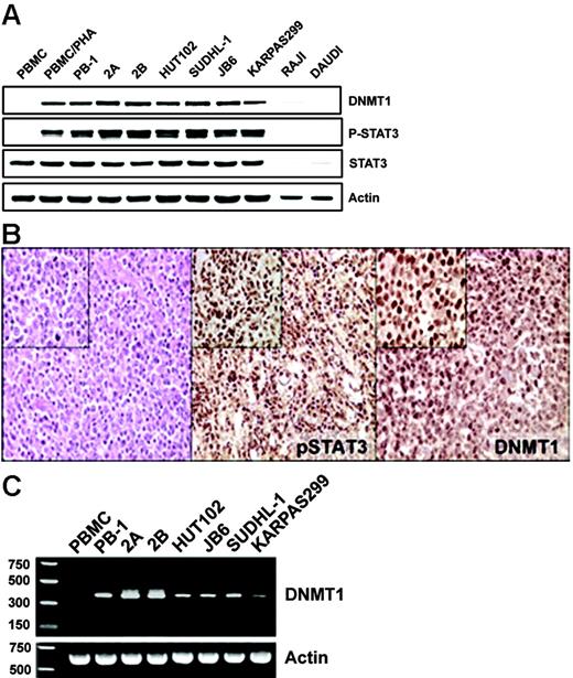 Figure 1. Coexpression of activated STAT3 and DNMT1 in malignant T-cell lymphoma cells. (A) Western blot analysis with the depicted antibodies of the nuclear protein extracts from cell lines derived from T-cell lymphomas involving skin (PB-1, 2A, 2B), HTLV-I–associated (HUT102B), and anaplastic lymphoma kinase–positive (SUDHL-1, JB6, Karpas 299) malignancies. Normal T-cell–rich PBMCs, both resting and PHA activated, and B cells (RAJI and DAUDI) served as controls. (B) Immunohistochemical analysis of the cutaneous T-cell lymphoma tissues. (left) Hematoxylin-eosin staining was used to visualize malignant T cells. (middle) Anti–phospho(p)-Y705STAT3 staining. (right) Anti-DNMT1 staining. Original magnification: larger images, 100 ×; insets, 400 ×. Depicted results that show coexpression of p-STAT3 and DNMT1 by malignant T cells are representative for all biopsy tissue samples of the 15 examined patients. (C) RT-PCR analysis of DNMT1 mRNA expression in the same diverse T-cell lymphoma cell line depicted in Figure 1A, with PBMCs serving as control.