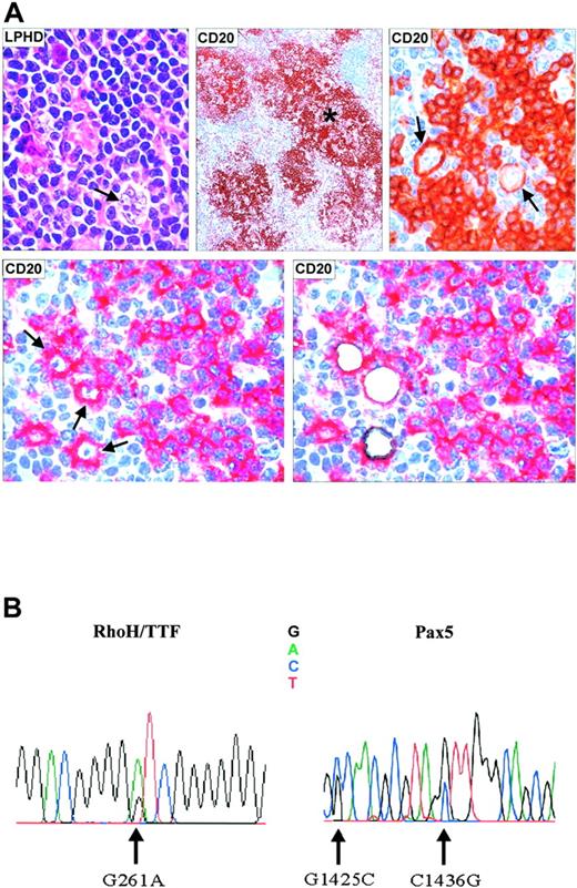 Figure 2. Microdissection and mutational analysis of a representative patient with NLPHL. (A) Lymph node biopsy showing a neoplastic nodule containing characteristic L/H cells with popcorn appearance of the nucleus (top left, hematoxylineosin stain; magnification, 800 ×). (Top middle, immunoperoxidase technique; magnification, ×150. L/H tumor cells are CD20+ (arrows) and are surrounded by a rim of CD20– rosette T cells (top right, immunoperoxidase technique; magnification, 800 ×). CD20+ L/H cells before and after laser microdissection (bottom, right and left) (APAAP technique). *CD20+ tumor nodule. (B) Electropherogram showing mutations of the RhoH/TTF and PAX5 genes in microdissected L/H cells (Table 2, patient 2).