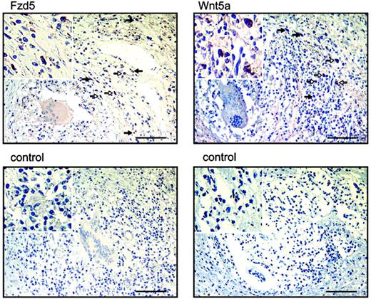 Figure 5. WNT5A and FZD5 expression in lung tissue of M tuberculosis–infected patients. Sections from lung biopsies of M tuberculosis–infected patients were stained for the presence of FZD5 protein (left column) and WNT5A mRNA (right column) as described in “Materials and methods.” Arrows indicate a selection of FZD5 resp. WNT5A-positive cells. Inserts represent a 3-fold magnification of the areas with positive cells defined by white arrows. Bar = 100 μm.