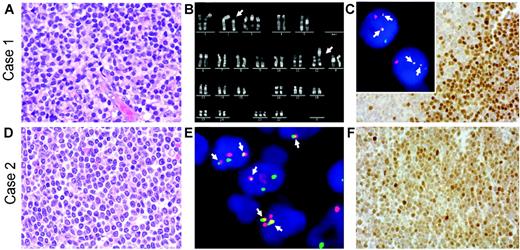 Figure 1. Histologic, immunophenotypic, and cytogenetic findings in 2 cyclin D1–negative/cyclin D2–positive MCLs with IGK-CCND2 fusion. (A,D) Hematoxylin and eosin (H&E)–stained lymph node biopsies of cases 1 (A) and 2 (D) showing the typical morphology of MCL. (B) Chromosome R-banding analysis of case 1 revealing the karyotype 48,XX,t(2;12)(p12;p13),+3,+21. (C insert, E) Interphase FISH analysis using double-color, double-fusion probes spanning the IGK (green) and CCND2 (red) loci.1,2 Both cells in case 1 (C insert) and several cells in case 2 (E) show 2 fusion (yellow, arrows) signals indicating IGK-CCND2 juxtaposition in addition to isolated red and green signals indicating intact CCND2 and IGK loci. (C,F) Cyclin D2 nuclear expression in the tumor cells detected by immunohistochemistry using a polyclonal anti–cyclin D2 antibody, as described recently.1 H&E images were visualized under a Zeiss Axioskop 40 microscope (Carl Zeiss, Jena, Germany) equipped with a 40 ×/0.75 objective lens and an RT Slider camera (Diagnostic Instruments, Sterling Heights, MI). Images were processed with MetaVue software (Diagnostic Instruments) and Adobe Photoshop (Adobe Systems, San Jose, CA). FISH images were acquired with a 63 ×/1.40 oil-immersion objective in a Zeiss Axioskop2 fluorescence microscope (Zeiss, Göttingen, Germany) equipped with the appropriate filter sets (AHF, Tübingen, Germany), and were documented and processed using the ISIS imaging system (MetaSystems, Altlussheim, Germany).