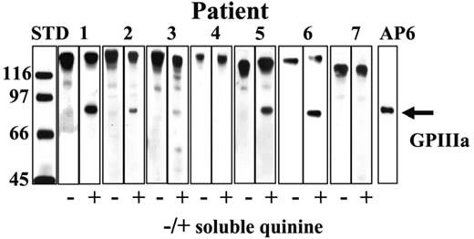 Figure 1. Patient samples contain drug-dependent antibodies that immunoblot GPIIIa in the presence of quinine. Patients 1, 2, 3, 5, and 6 had IgG antibodies that recognized a protein corresponding to GPIIIa in the presence but not in the absence of 0.4 mM quinine (immunoblot against whole platelet lysate). GPIIIa is marked with monoclonal AP6 specific for amino acid residues 211-221. The prominent high-molecular-weight bands correspond to naturally occurring platelet IgG.