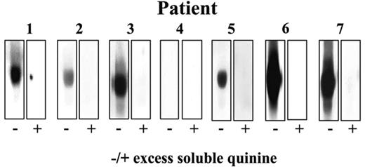 Figure 3. Patient samples contain drug-specific antibodies that recognize Qn-HSA. Patients 1, 2, 3, 5, 6, and 7 had antibodies that recognized Qn-HSA in an immunoblot and were inhibited by soluble quinine 0.4 mM. None of the antibodies recognized unmodified HSA (not shown).