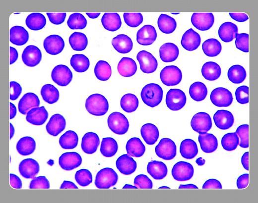Figure 1. A 69-year-old man with lung cancer had been undergoing chemotherapy. Drug-associated moderate pancytopenia was treated with red cell transfusions. One week afterward, anemia became more pronounced. When unexplained fevers without serious leukopenia complicated his course, he was admitted for an assessment and antibiotics. A peripheral smear in this nontraveler explained his febrile course. A malarial parasite can be seen in the red blood cell just right of center. . / The Centers for Disease Control was alerted. Tracing blood donors to this patient uncovered an individual who recently returned to the United States after visiting family and friends in Central Africa. Embarrassingly, he admitted to not taking his antimalaria prophylaxis. . / Neil Abramson, Baptist Cancer Institute