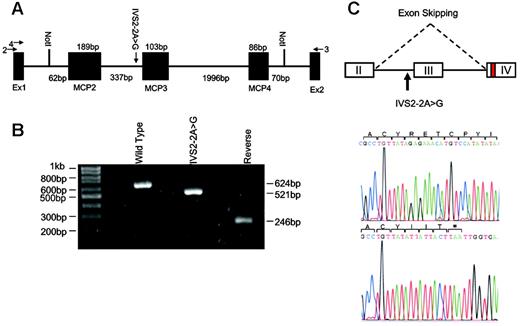 Figure 1. Modeling of IVS2 –2A>G mutation in MCP. (A) The pET (MoBiTec) exon traps cloning vectors containing wild-type or mutated genomic DNA from intron 1 (IVS1 –62) to intron 4 (IVS4 +70) of MCP. The vectors were transfected into 293T cells and the products were analyzed by RT-PCR and sequencing. Arrows 2 and 3 are the primers used for RT-PCR. Arrow 4 is the primer used for sequencing of cDNA product. MCP2, MCP3, and MCP4 indicate exons II, III, and IV of MCP. (B) Ethidium bromide–stained 1.5% agarose gel of RT-PCR products from splicing assays of transfected 293T cells. The wild-type minigene generated a product of 624 bp containing MCP exons II, III, and IV, whereas the IVS2 –2A>G mutant minigene produced a product of 521 bp lacking exon III. The wild-type sequence inserted in the reverse orientation gave a product (246 bp) that did not contain any spliced product. (C) Sequencing of cloned RT-PCR product. The RT-PCR products were subcloned into pCR2.1-TOPO and sequenced. The IVS2–2A>G mutation results in skipping of exon III. This alteration predicts a 34–amino acid loss (62-95del) in SCR2 followed by 3 amino acid changes (G96I +Y97I + Y98T) and a premature stop at L99.