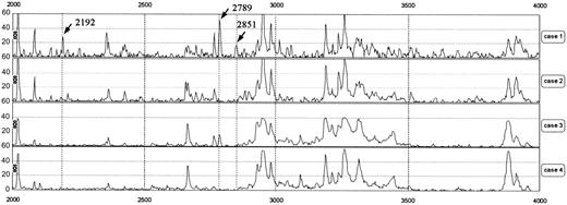 Figure 1. Representative protein mass spectra in the range of 2000 to 4000 m/z. Cases 1 and 2 were patients receiving hemodialysis and cases 3 and 4 were volunteers with normal renal function. Peaks at 2192, 2789, and 2851 m/z were observed in case 1 but not in cases 2 and 4. In case 3, the peak at 2789 m/z was slightly increased. r indicates Pearson correlation coefficient.