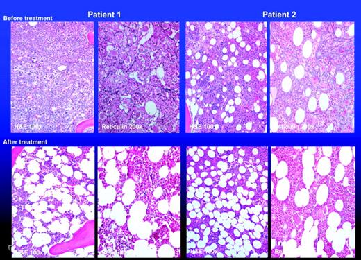 Figure 1. Bone marrow histology (hematoxylin-eosin as well as reticulin stain) before and after treatment with lenalidomide in 2 patients with myelofibrosis with myeloid metaplasia who achieved major anemia response as well as resolution of peripheral-blood leukoerythroblastosis. The 2 patients represent patients 1 and 2 from Table 5. Images were obtained by using a Leeds Olympus AX70 microscope (Olympus, Minneapolis, MN) equipped with a 160×/0.4 objective lens and a Nikon DXM1200 digital camera (Nikon, Melville, NY); Nikon ACT-1 software version 2.62 was used to acquire digital images. No further image processing was conducted.
