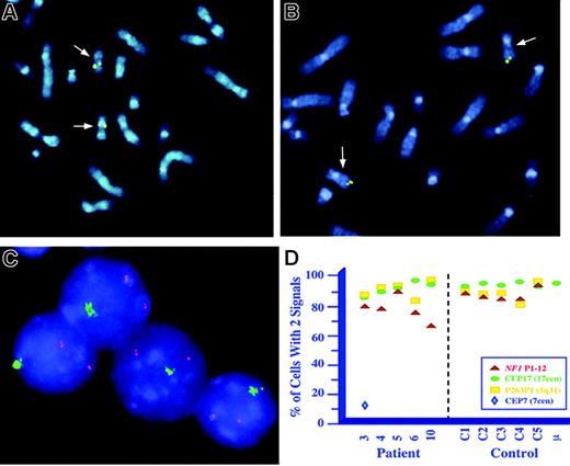 Figure 2. FISH analysis of NF1-associated myeloid malignancies. (A-B) Metaphase spreads of EBV-transformed cells from patient 1 that were hybridized with NF1 probe P1-12 (A) and BAC clone 1000G21, which contains the D17S928 locus at 17q25 (B). Each of 20 metaphase cells examined showed signals on both chromosome 17 homologs, consistent with disomy. The chromosome 17 homologs were identified by Hoechst-actinomycin D staining, which reveals a Q-banding-like pattern. (C) Dual-color FISH performed by cohybridizing a digoxigenin-labeled probe P1-12 (rhodamine signal) and an α-satellite probe specific for the centromere of chromosome 7 (CEP7, SpectrumGreen), which showed monosomy 7 and NF1 disomy in bone marrow cells from patient 3. Interphase nuclei were counter-stained with DAPI, and the slides mounted with PDD antifade solution. Images were visualized using a Zeiss Axioplan microscope equipped with a 63×/1.25 NA oil Plan Neofluar lens, Optivar setting 1.6. Images were acquired using a Photometrics cooled charge-coupled device (CCD) camera (Photometrics, Tucson, AZ) and NIH Image software (National Institutes of Health, Bethesda, MD), and were processed using Adobe Photoshop. (D) Graphic summary of interphase FISH analyses of myeloid leukemia cells with NF1 (red triangle) and control probes. Probe 263P1 is a 70-kb PAC clone containing D5S479 (chromosome band 5q31; yellow squares). CEP17 is a centromere-specific probe for chromosome 17 (green circles), and CEP7 is a centromere-specific probe for chromosome 7 (blue diamond). C1 is a cryopreserved bone marrow sample from a patient with AML-M4 in complete remission. Control samples C2 through C5 are cryopreserved bone marrow samples from 4 children with myeloid leukemias that retained heterozygosity at the NF1 locus. The mean distribution of signals for the chromosome 17 centromere-specific probe was determined by the interphase analysis of bone marrow cells from 10 healthy individuals. This graph is a summary of data given in Table S2.