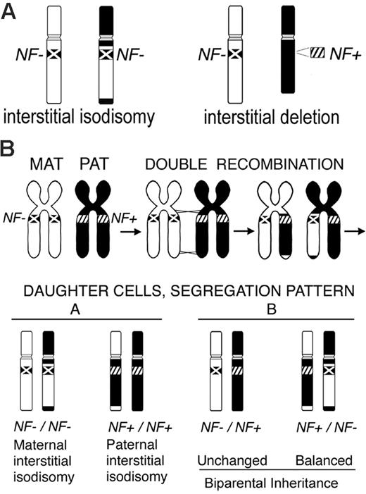 Figure 3. LOH in NF1-associated myeloid malignancies and proposed mechanism of interstitial isodisomy. (A) The schematic depicts the 2 different patterns of LOH observed in the tumors. The inactivated NF1 allele (NF-) is marked with an X on the chromosome, while the normal NF1 allele (NF+) is indicated by diagonal hashmarks (////). The interstitial isodisomic and deleted regions can be of maternal or paternal origin. (B) Proposed mechanism for double mitotic recombination during the S/G2 phase of the cell cycle leading to interstitial uniparental isodisomy in a leukemic-initiating cell. The 4 possible daughter cells are depicted, along with their NF1 genotypes and disomy patterns. Although this example depicts a cell with maternal interstitial isodisomy and NF1 inactivation, paternal interstitial isodisomy was also observed in our study (Figure 1).