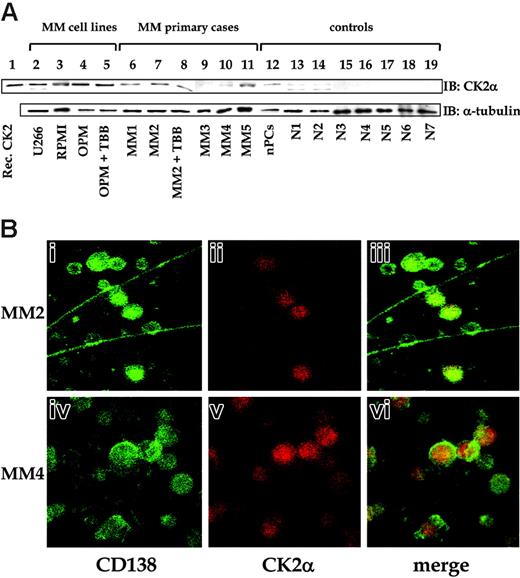 Figure 2. CK2α expression in MM cells. (A) Top panel: Western blot for CK2α. Bottom panel: Corresponding Western blot for α-tubulin as a loading control (different sets of experiments are shown). Analyses were performed on the same samples as in Figure 1, corresponding to MM cell lines (lanes 2-5, U266, RPMI, or OPM, as indicated), CD138+ purified plasma cells from 5 MM patients (lanes 6-11), normal plasma cells (lane 12, indicated as nPCs), normal CD19+ B lymphocytes purified from 7 healthy donors (lanes 13-19). In lane 1, recombinant CK2α was loaded as a positive control; in lanes 5 and 8, TBB (2 μM) was added in vitro to exclude the effects on CK2α levels. (B) Results of 2 representative experiments of immunofluorescence microscopy on freshly isolated bone marrow cells from 2 MM patients stained with an antibody recognizing the specific plasma cell marker CD138 (i,iv; green fluorescence), anti-CK2a (ii,v; red fluorescence), and merged images (iii,vi). Original magnification × 60, oil objective.