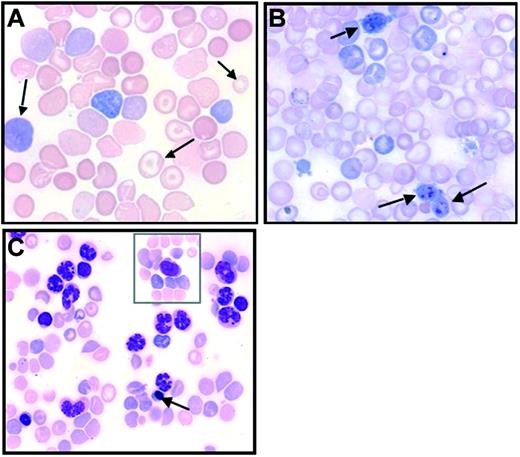 Figure 3. Abnormal blood cell features. Blood smears from JAK2V617F virus-recipient mice in late posttransplantation stages (May-Grünwald-Giemsa staining). (A) Abnormal RBCs (arrows) showing polychromatophilia, anisocytosis, and the presence of target cells. (B) Giant platelets (arrows). (C) Elevated granulocytosis with erythroblastosis (arrow), and rare blast cells (in inset). Images were obtained using a Zeiss Axiophot microscope, Zeiss Pan-Apochromat 63×/1.40 oil (A) or 40×/1.0 oil (B-C) lenses, a Zeiss AxioCam Mrc camera, and the AxioVision Rel.4.3 acquisition software (all from Zeiss, Oberkochen, Germany).