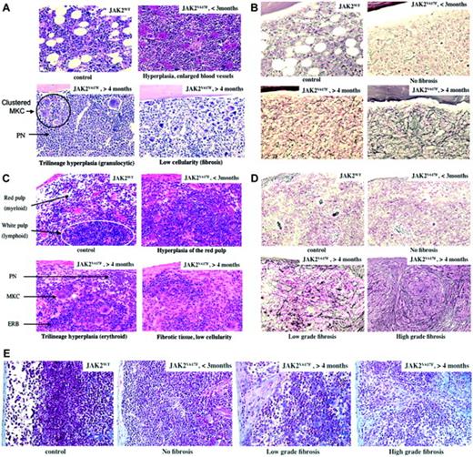 Figure 5. Histology. Hematoxylin-eosin (A,C), silver stain (B,D), and trichrome (E) colorations of the marrow (A-B) and spleen (C-E) are shown. Control (JAK2WT) and JAK2V617F-recipient mice with posttransplantation time (< 3 months or > 4 months) are indicated with main features: trilineage hyperplasia in early stages and fibrosis/low cellularity in late stages. Images were obtained using a Leica DMRB microscope (Leica, Solms, Germany) with lenses ×20 (0.5 numeric aperture) × 10 = 200 × total magnification, and acquired with a Video 3 charge-coupled device (CCD) Sony Leica Power hole accumulated diode (HAD) camera (Sony, Tokyo, Japan).