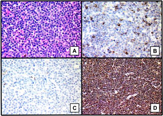 Figure 1. Histopathologic features of marginal zone B-cell lymphoma or MALT lymphomas. These lymphomas are defined by the presence of lymphoepithelial lesions and proliferation of tumor cells composed primarily of small cells (A). One of the major immunophenotypic characteristics is the presence of extensive, dense, packed CD20+ B-cell lymphoid infiltrate (D). A few CD3+ T lymphoid cells are interspersed within the B cells (B). The lymphoid cells are also CD10- (C). Images were captured with a Leitz DM-RB microscope equipped with a 40x/0.70 NA objective lens and a JVC 3-CCD camera (KY-F50; Claravision, Massy, France). Images were processed with Claravision software and Adobe Photoshop (Adobe Systems, San Jose, CA). Images in panel A were stained with hematein-eosin-safran staining; those in panel B, with anti-CD3 immunostaining (polyclonal antibody A0452; Dakocytomation, Glostrup, Denmark); those in panel C, with anti-CD10 immunostaining (monoclonal antibody 56C6, NCLCD10; Novocastra, Newcastle upon Tyne, United Kingdom); and those in panel D, with anti0CD20 immunostaining (monoclonal antibody L26, Dakocytomation).
