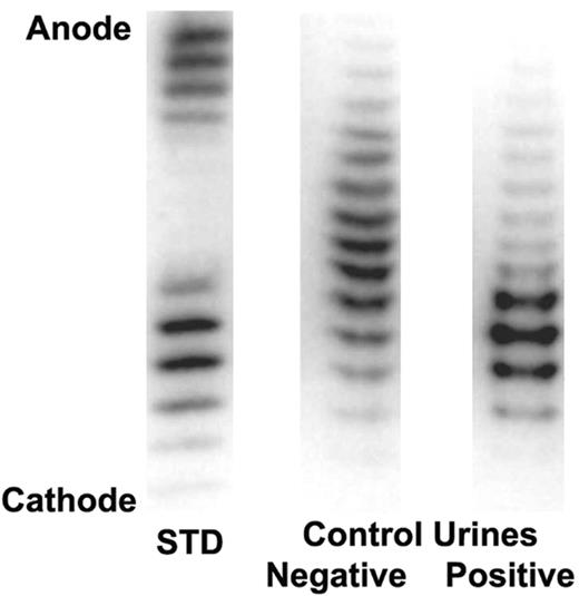 Figure 1. Electropherogram showing a darbepoetin alfa/rhEpo standard (left lane) and human quality control urines. The darbepoetin alfa/rhEpo standard is on the left, the negative human quality control urine (from a known rhEpo-free donor) is in the middle, and the positive human quality control urine (pooled from known donors on rhEpo) is on the right.