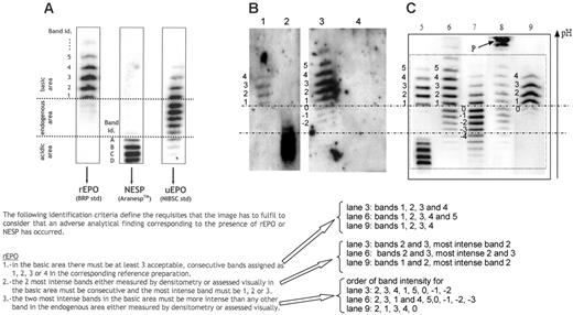 Figure 1. Epo profiles obtained by double immunoblotting. (A) Acceptance criteria for rhEpo, as defined by WADA.1 (B) Figure 1A from Beullens et al.2 Lane 1, epoetin β; lane 2, darbepoietin α; lane 3, “false-positive” urine sample collected immediately after exercise; lane 4, negative urine sample collected 1 hour after the sample in lane 3. (C) Figure 1 from Lasne. Lane 5, mixture of epoetin β and darbepoietin α; lane 6, urine sample after strenuous exercise; lane 7, natural urinary Epo; lane 8, urine sample showing protein P, unrelated to Epo; lane 9, urine sample in case of epoetin administration. Bands in panels B and C are numbered according to the criteria defined in panel A. Using the acceptance criteria of panel A, lanes 3 (panel B), 6, and 9 (panel C) should be considered as an adverse analytical finding corresponding to the presence of rhEpo.