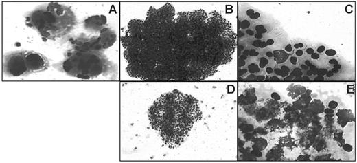 Figure 1. Typical colonies observed in ET and in RARS with ET features. Colonies are shown after May-Grünwald-Giemsa staining of collagen gels and are typical of ET (A-C) or of RARS with ET features (D-E). (A) Endogenous megakaryocytic colony, grown without serum or cytokine. (B,D) Erythroid colonies grown in the presence of cytokines; note the small size of the RARS colony (D). (C) Detail of erythroblasts of the colony shown in panel B. (E) Detail of erythroblasts of the colony shown in panel D; note extensive cell death. Images were obtained using a Leica microscope (Leica Microsystems, Wetzlar, Germany) equipped with a 10×/0.80 numeric aperture (NA) (A,B,D) or a 100×/0.80 NA (C,E) objective. Images were acquired using a Sony Power HAD DXC-950P camera (Sony, Tokyo, Japan) and Tribun ICS/Thunder 17 acquisition software. Images were processed using Microsoft PowerPoint 2000 (Microsoft, Redmond, WA).